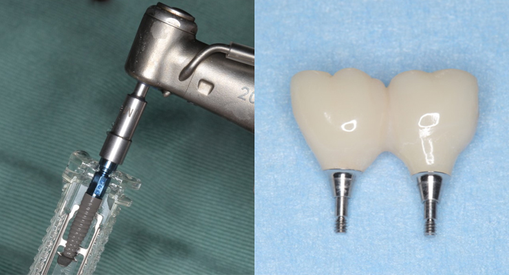 美しく(精密な手術と高品質なインプラント・かぶせもの)
