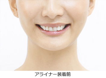 アライナー装着前