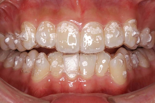 アライナー矯正