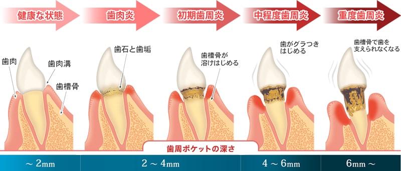 歯周病の進行状況
