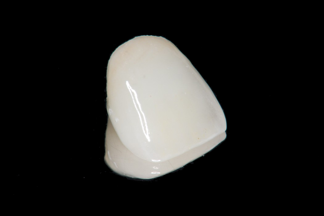 オールセラミッククラウン